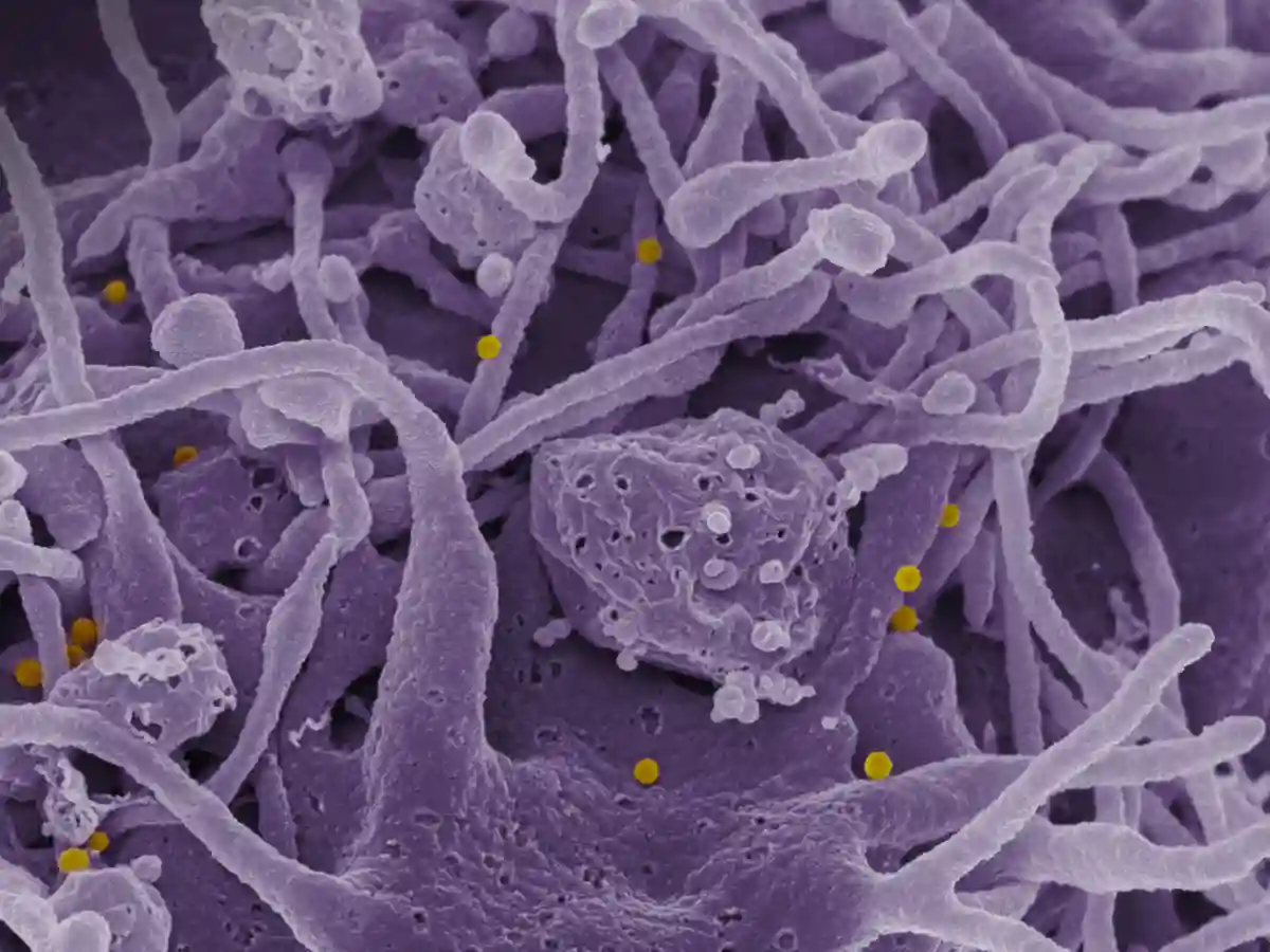 Scanning electron micrograph of Crimean-Congo hemorrhagic fever Scanning electron micrograph of Crimean-Congo hemorrhagic fever