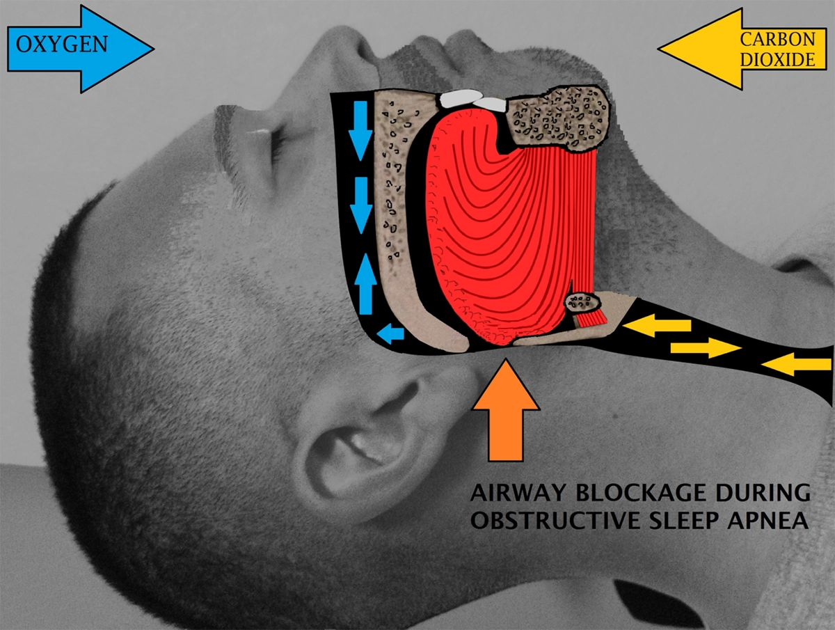 Obstructive Sleep Apnea 21.7.2025