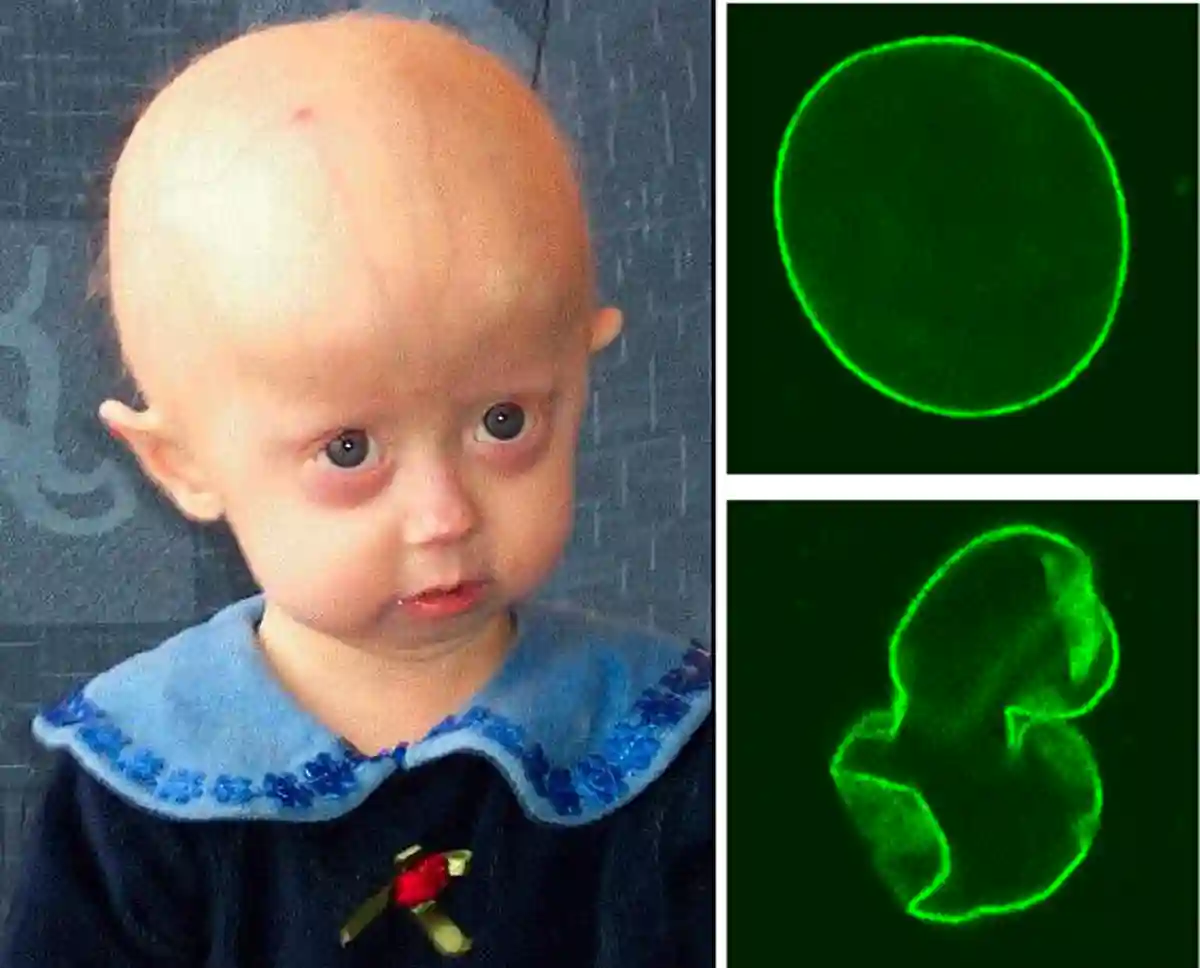 HGPS is a childhood disorder caused by mutations in one of the major architectural proteins of the cell nucleus HGPS is a childhood disorder caused by mutations in one of the major architectural proteins of the cell nucleus
