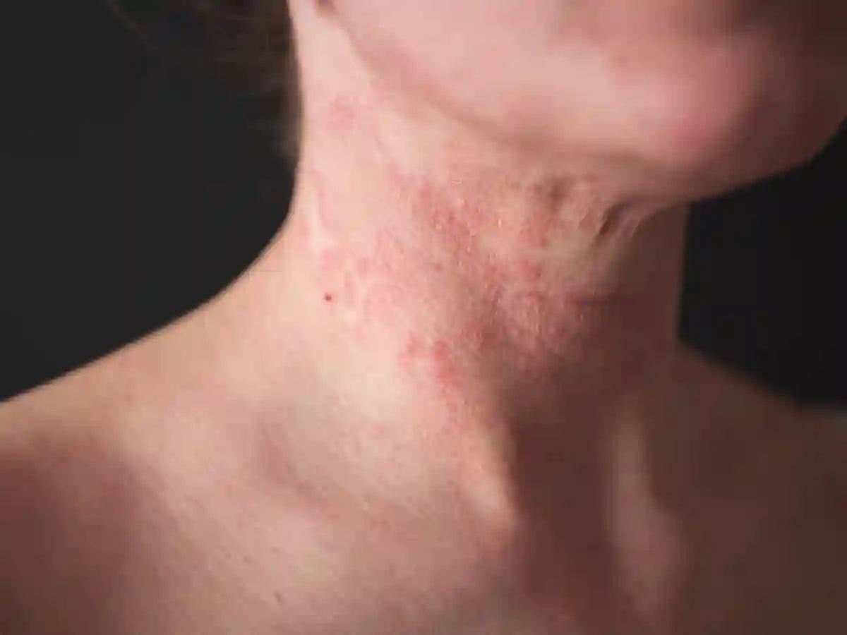image showing Aquagenic Urticaria disorder image showing Aquagenic Urticaria disorder